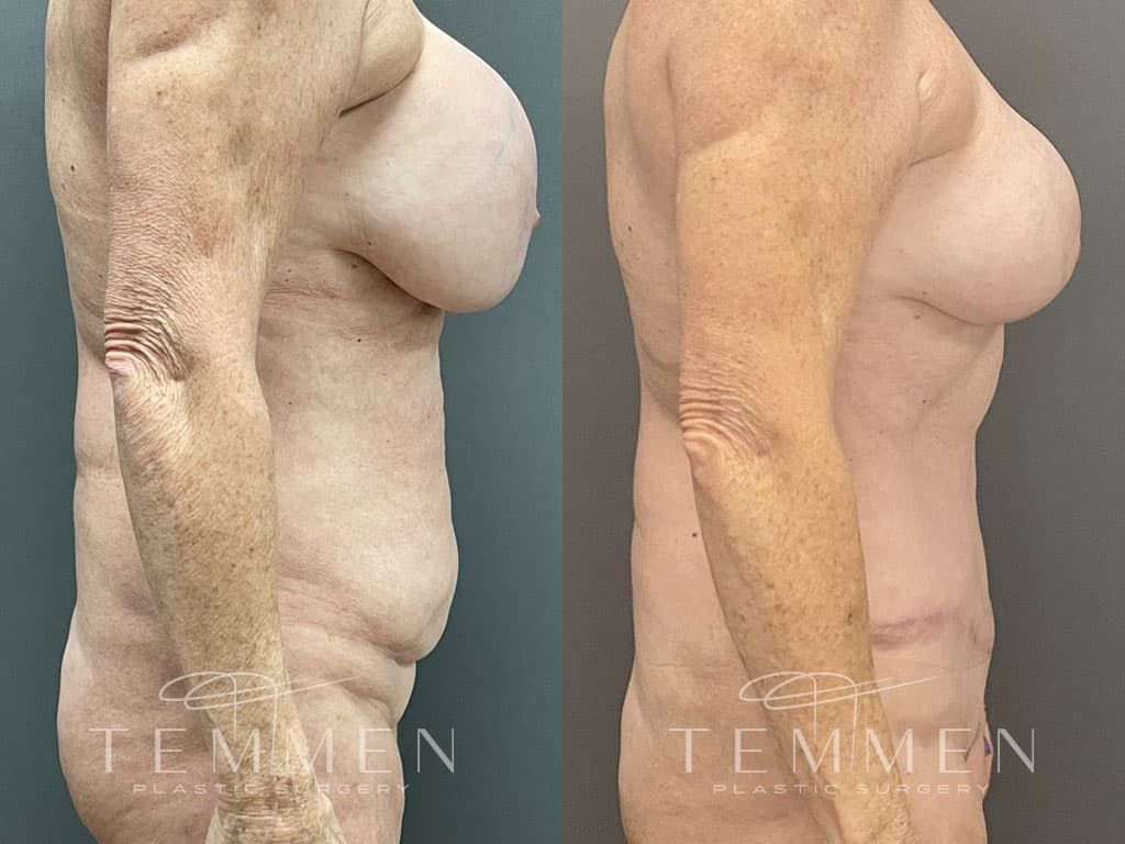 Breast Lift Before & After