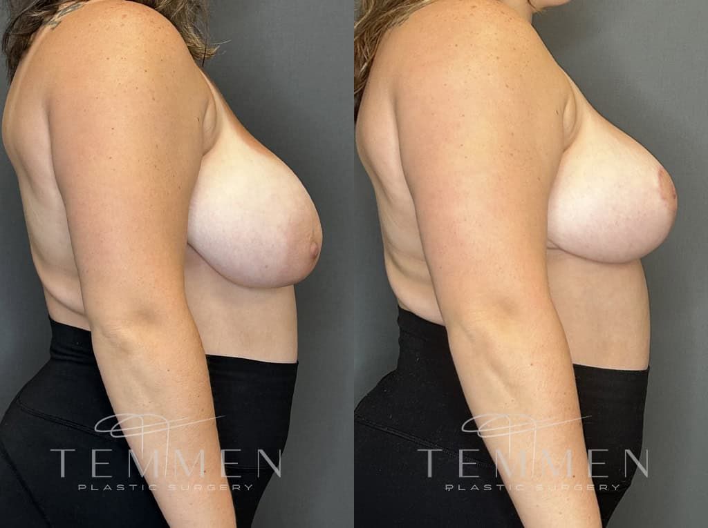 Breast Lift Before & After