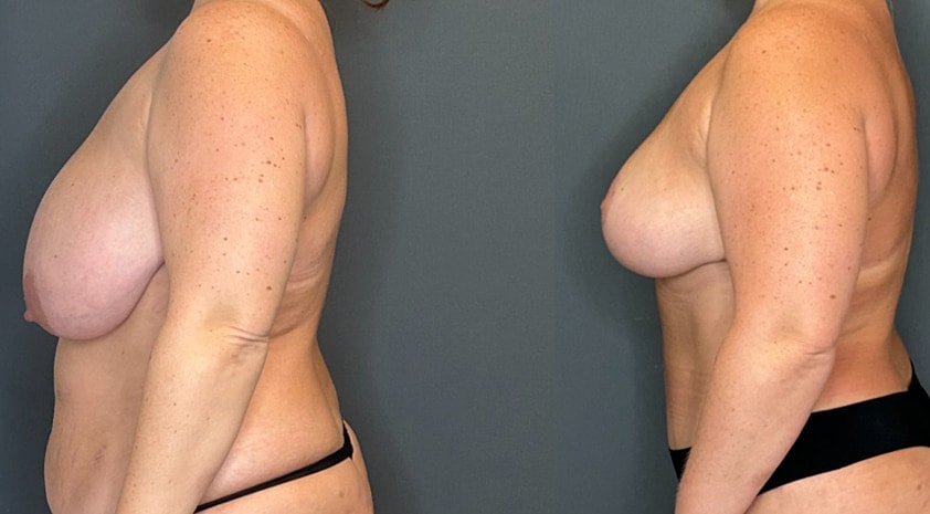 Breast Lift Before & After
