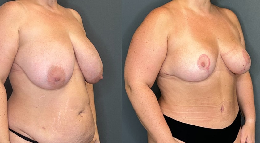 Breast Lift Before & After