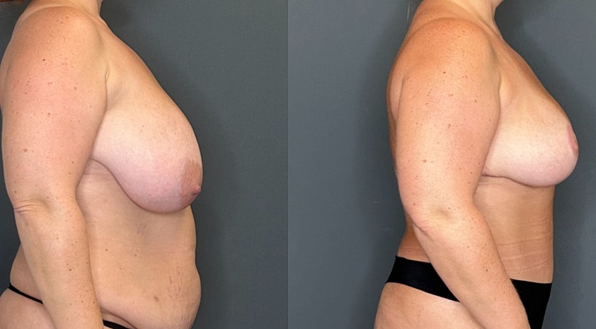Breast Lift Before & After