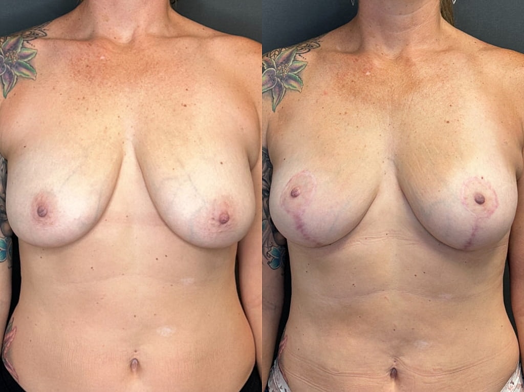 Breast Lift Before & After