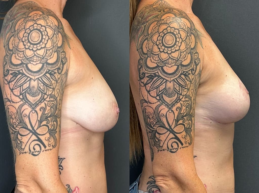 Breast Lift Before & After