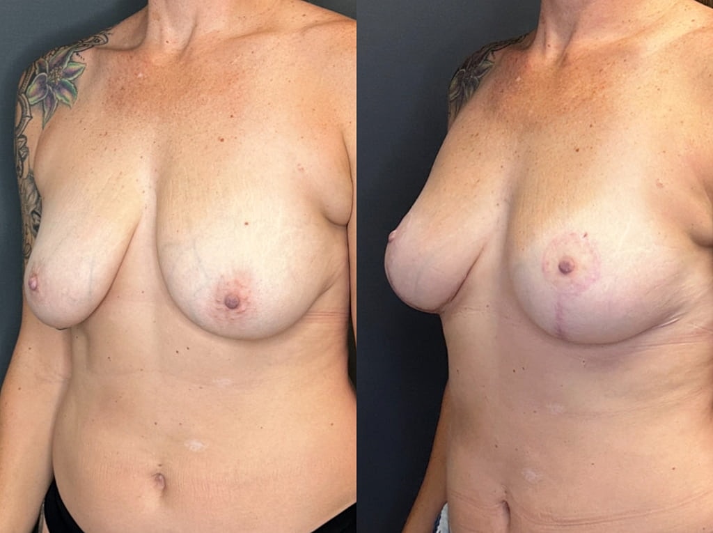 Breast Lift Before & After