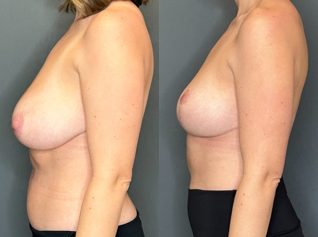 Breast Lift Before & After