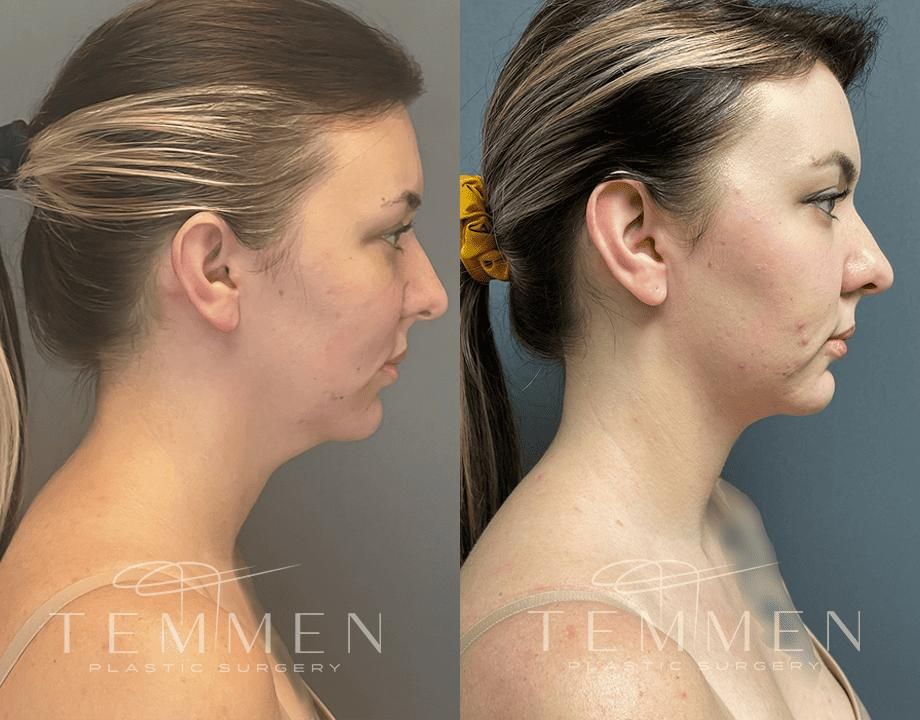 Face Liposuction Before & After