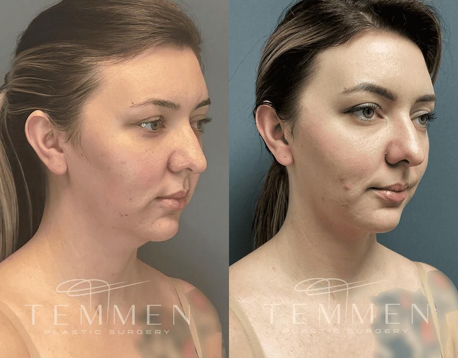 Face Liposuction Before & After