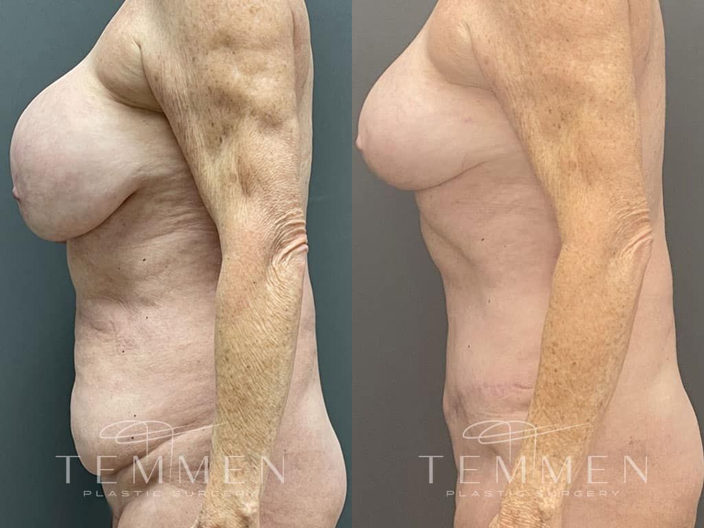 Implant Removal With Fat Transfer Before & After