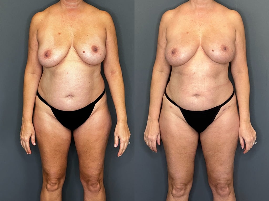 Implant Removal With Fat Transfer Before & After