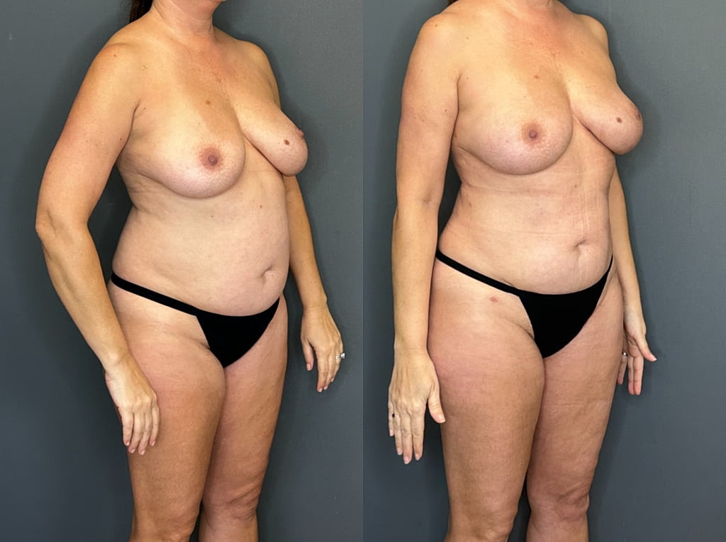 Implant Removal With Fat Transfer Before & After