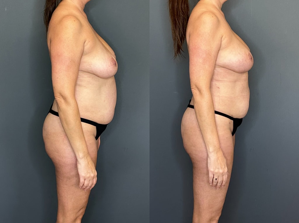 Implant Removal With Fat Transfer Before & After