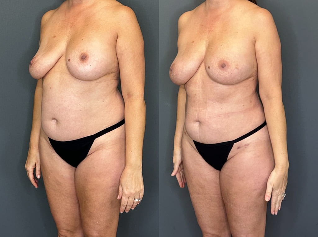Implant Removal With Fat Transfer Before & After