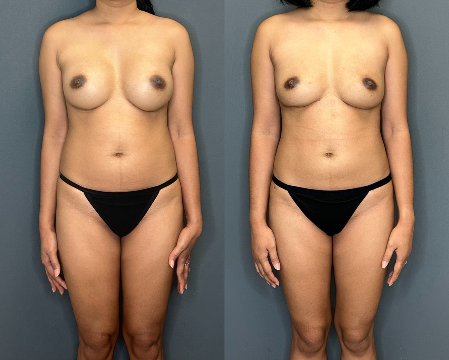 Implant Removal With Fat Transfer Before & After