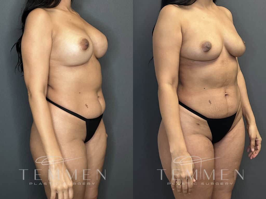 Implant Removal With Fat Transfer Before & After