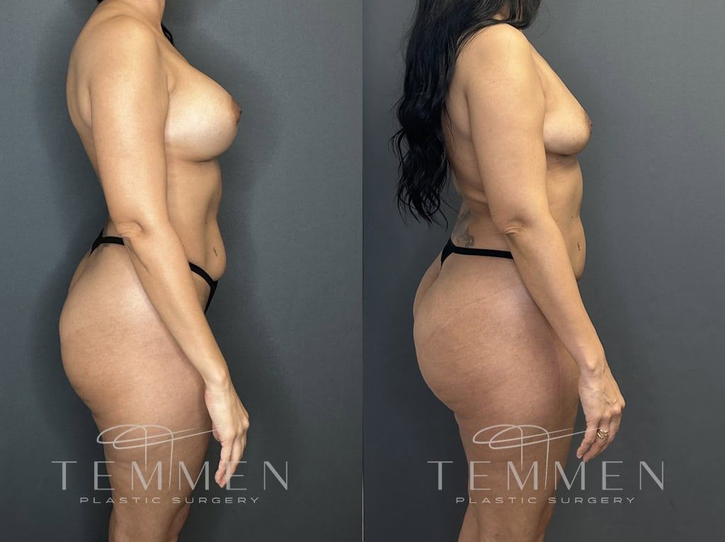 Implant Removal With Fat Transfer Before & After