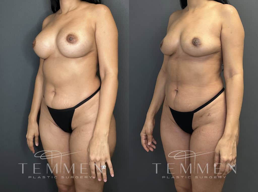 Implant Removal With Fat Transfer Before & After