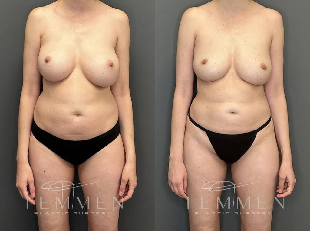 Implant Removal With Fat Transfer Before & After