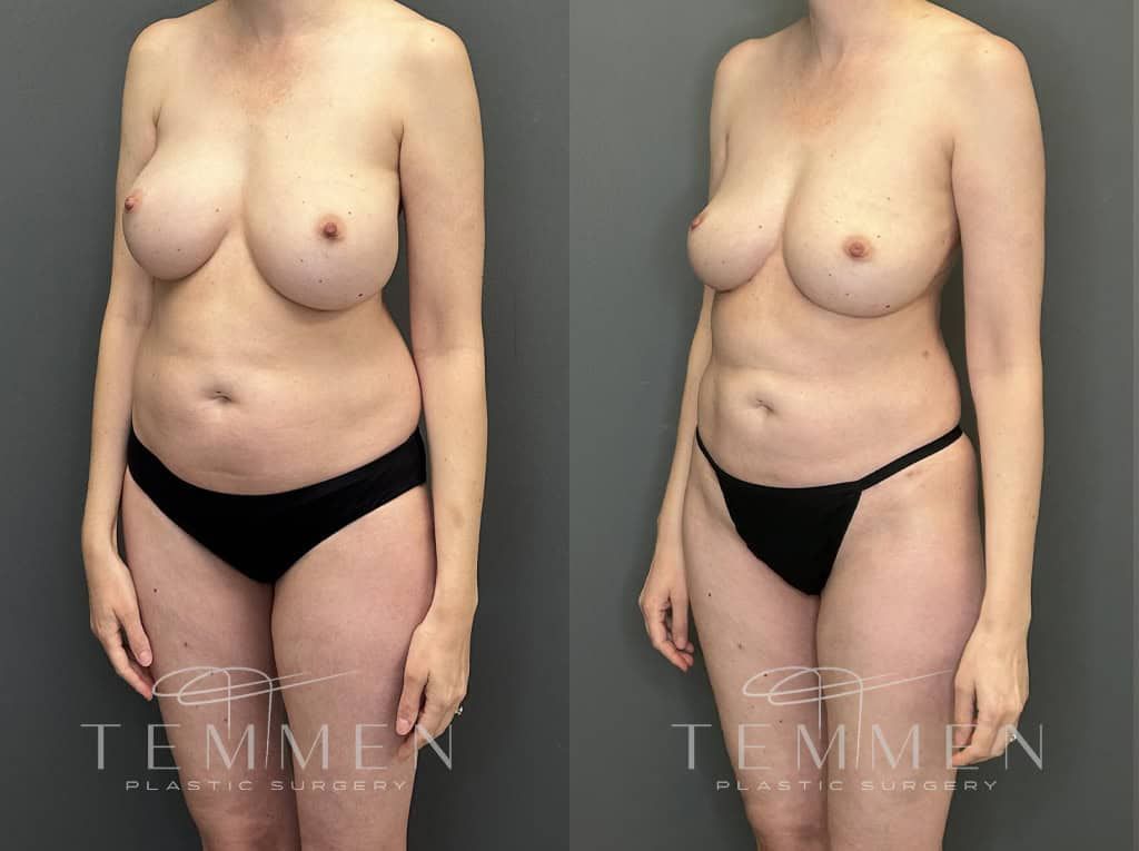 Implant Removal With Fat Transfer Before & After