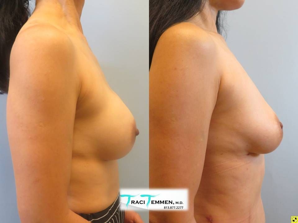 Implant Removal With Fat Transfer Before & After