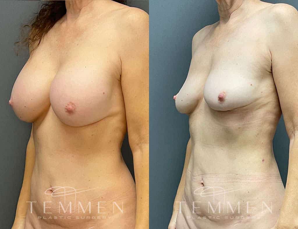 Implant Removal With Fat Transfer Before & After