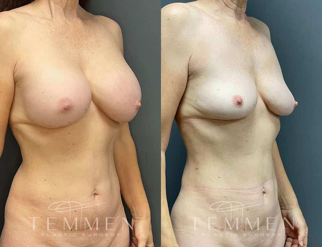 Implant Removal With Fat Transfer Before & After