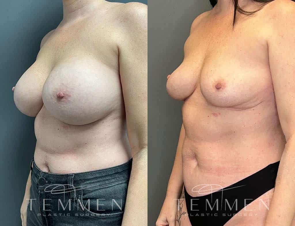 Implant Removal With Fat Transfer Before & After