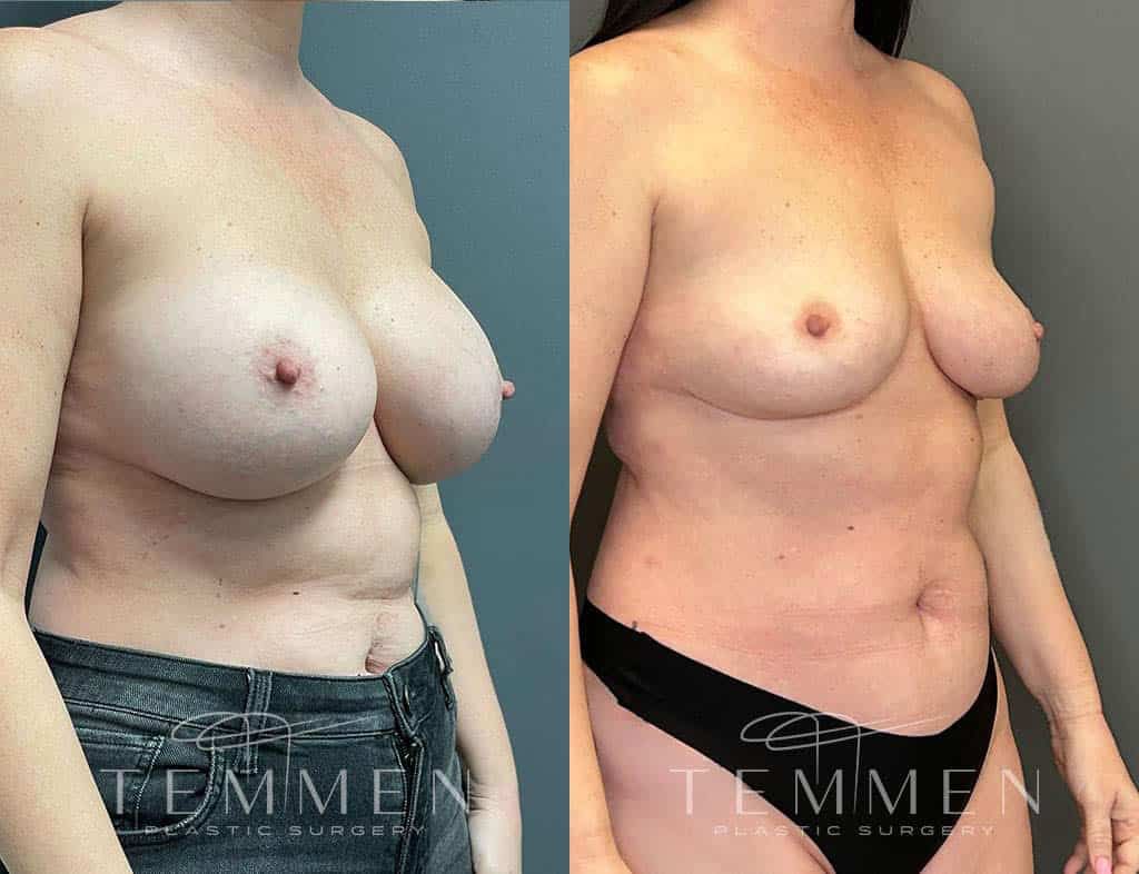 Implant Removal With Fat Transfer Before & After
