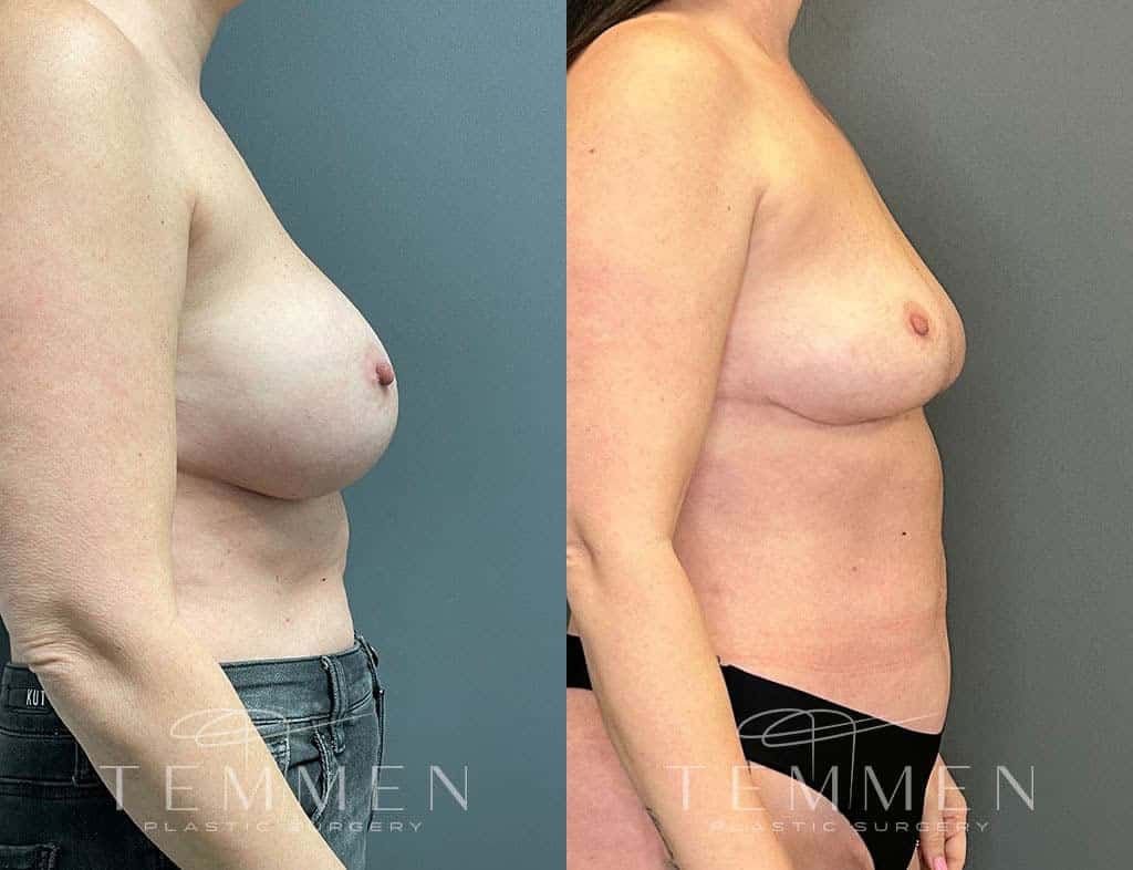 Implant Removal With Fat Transfer Before & After