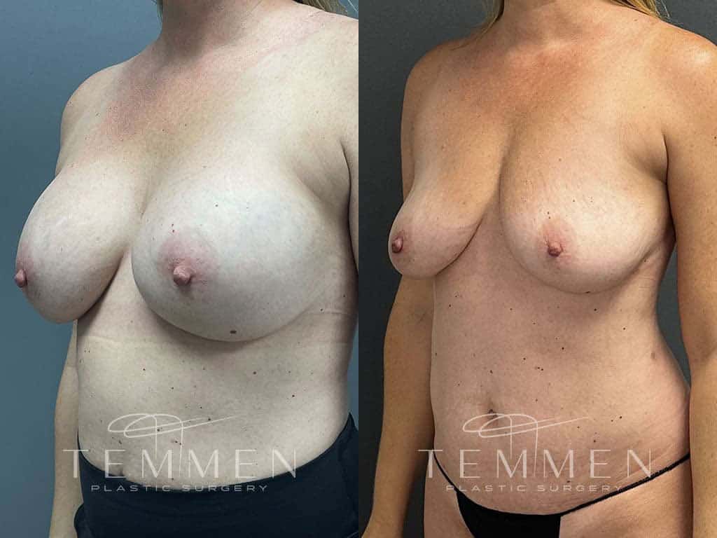 Implant Removal With Fat Transfer Before & After