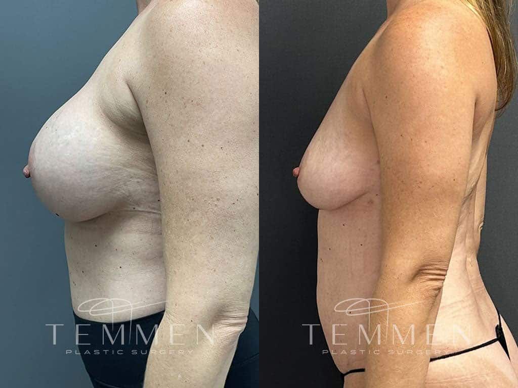 Implant Removal With Fat Transfer Before & After