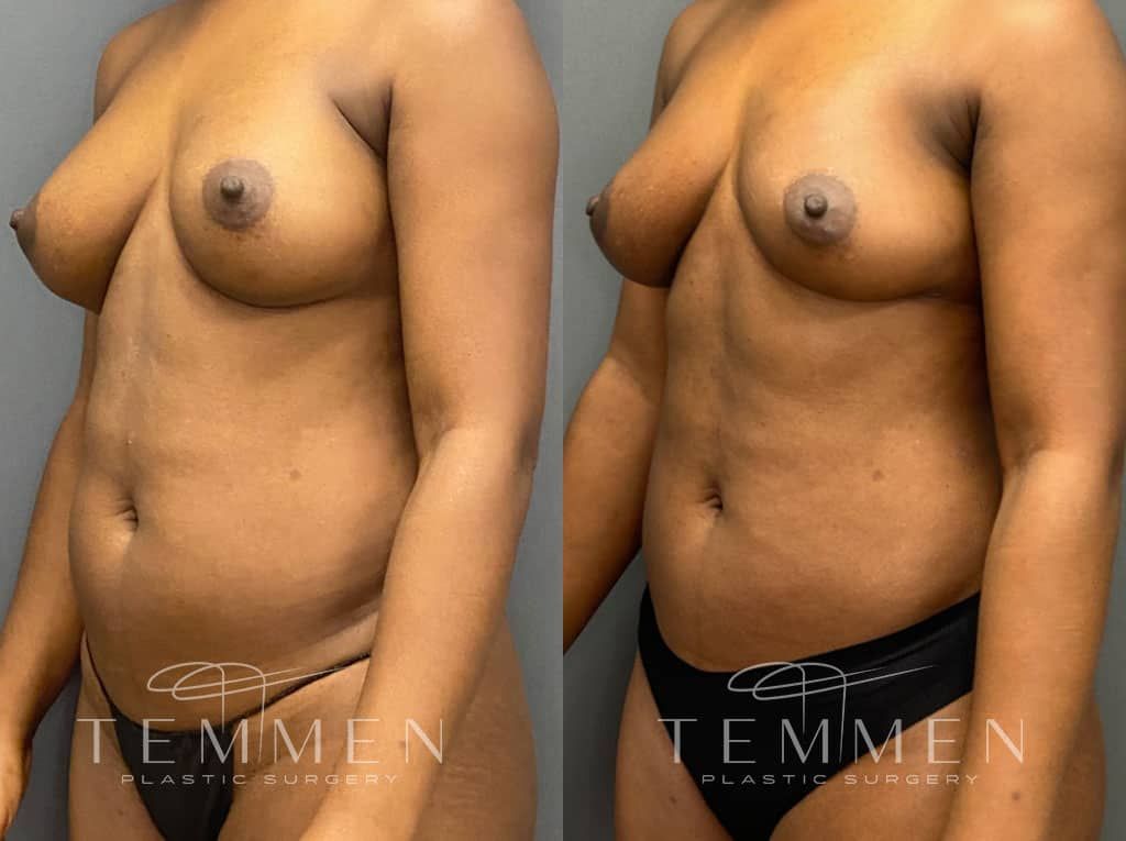 Implant Removal With Fat Transfer Before & After