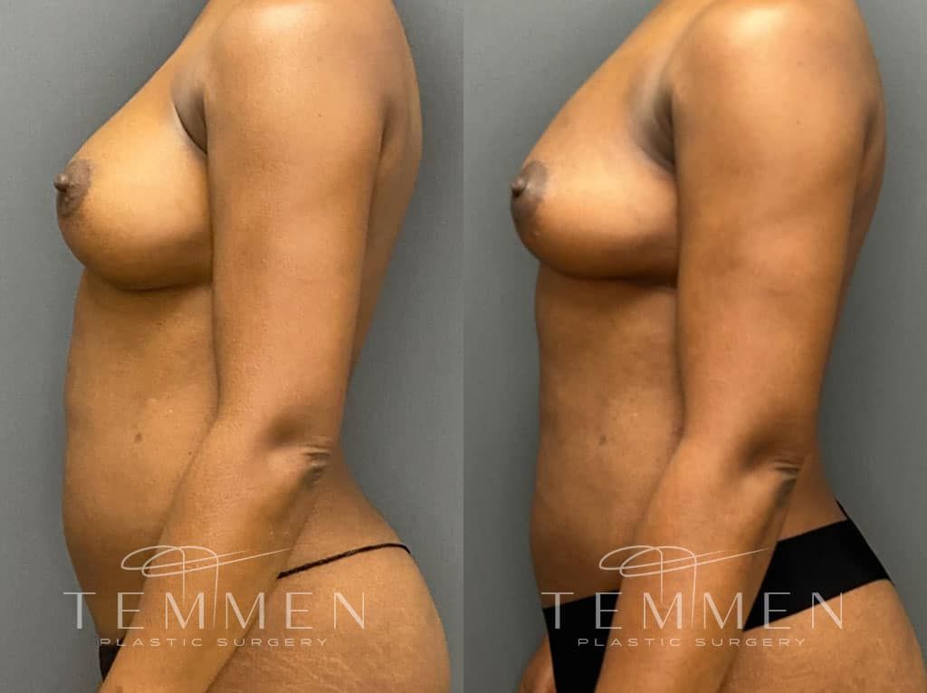 Implant Removal With Fat Transfer Before & After