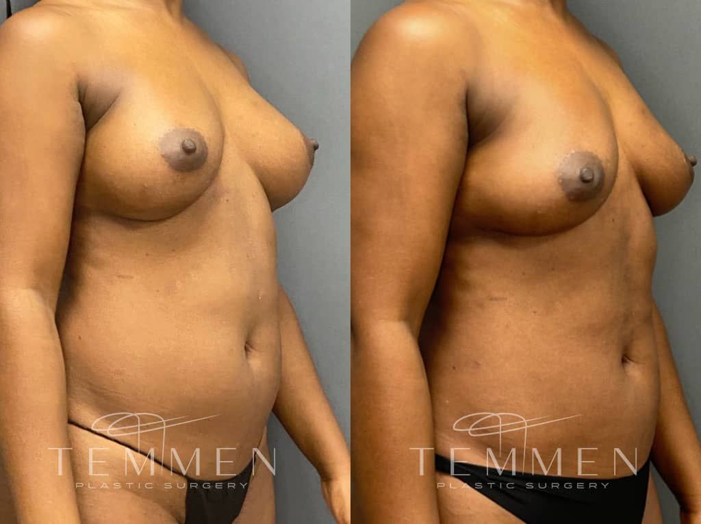 Implant Removal With Fat Transfer Before & After