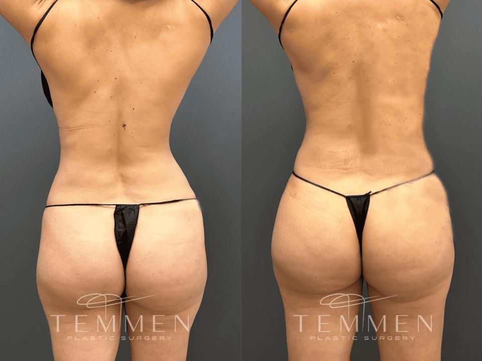 Brazilian Butt Lift Before & After