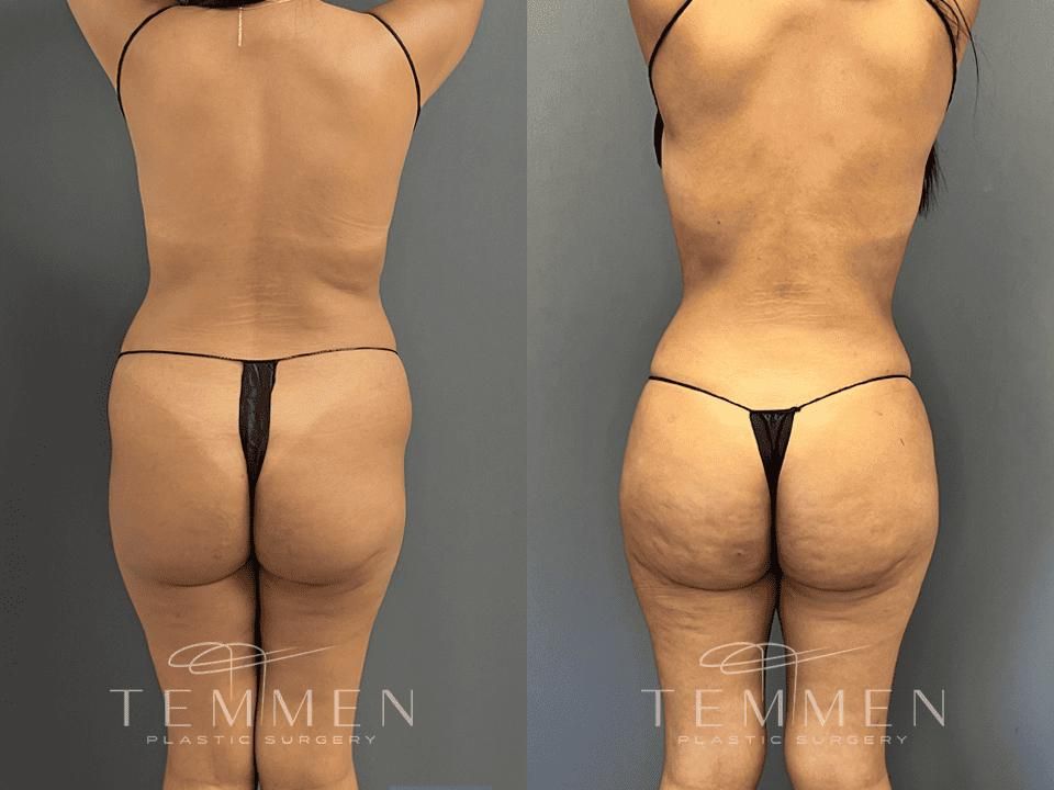 Brazilian Butt Lift Before & After