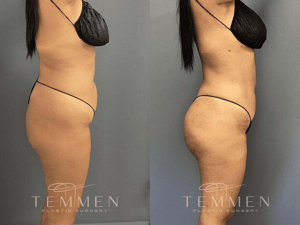 Brazilian Butt Lift Before & After