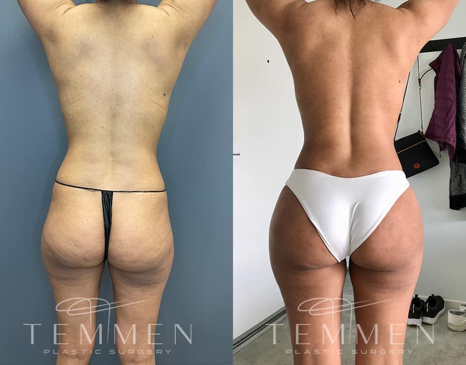 Brazilian Butt Lift Before & After