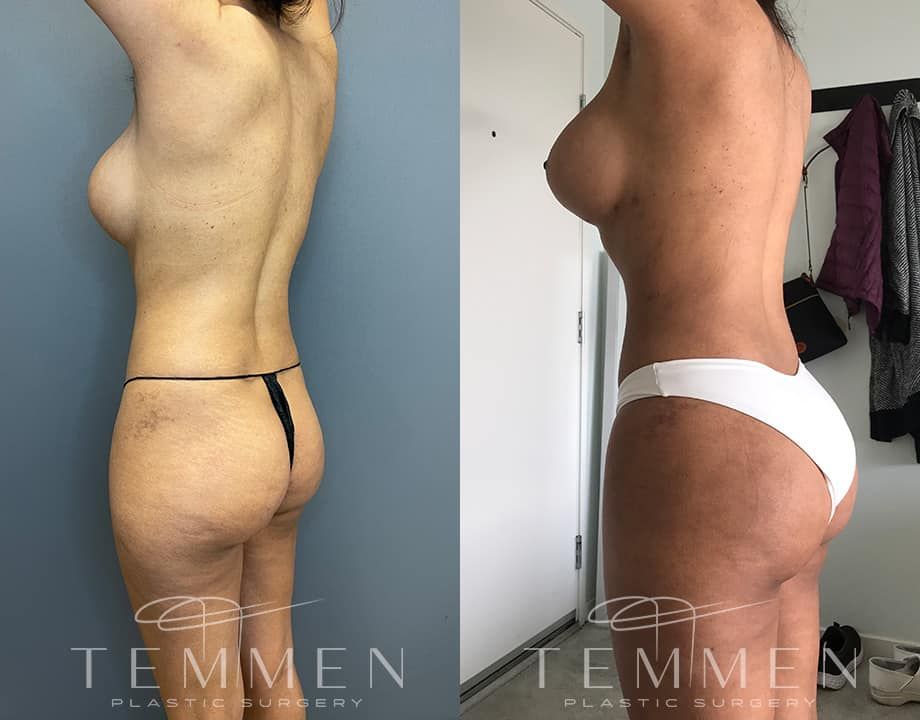 Brazilian Butt Lift Before & After
