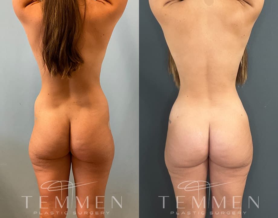 Brazilian Butt Lift Before & After