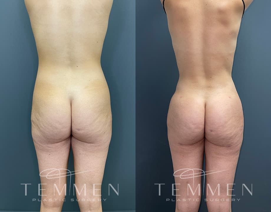 Brazilian Butt Lift Before & After