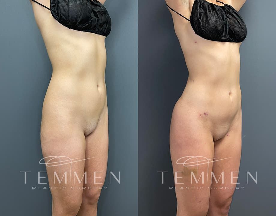 Brazilian Butt Lift Before & After