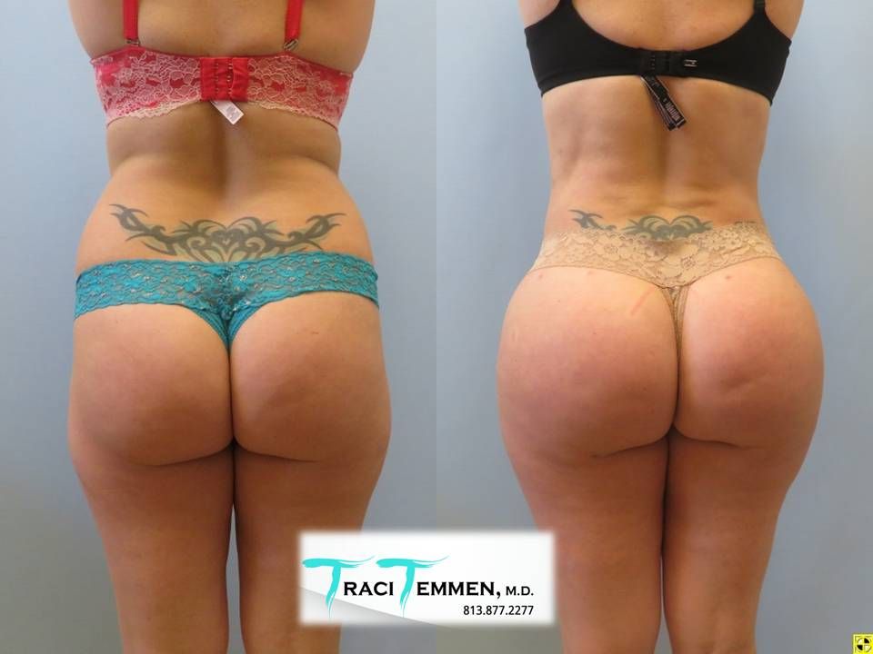 Brazilian Butt Lift Before & After