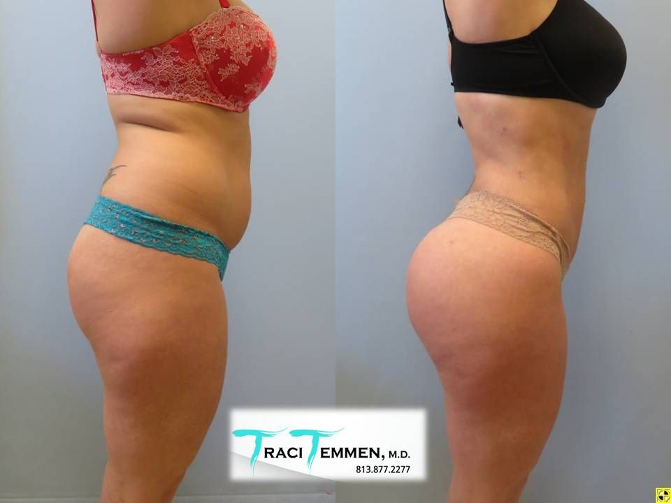 Brazilian Butt Lift Before & After