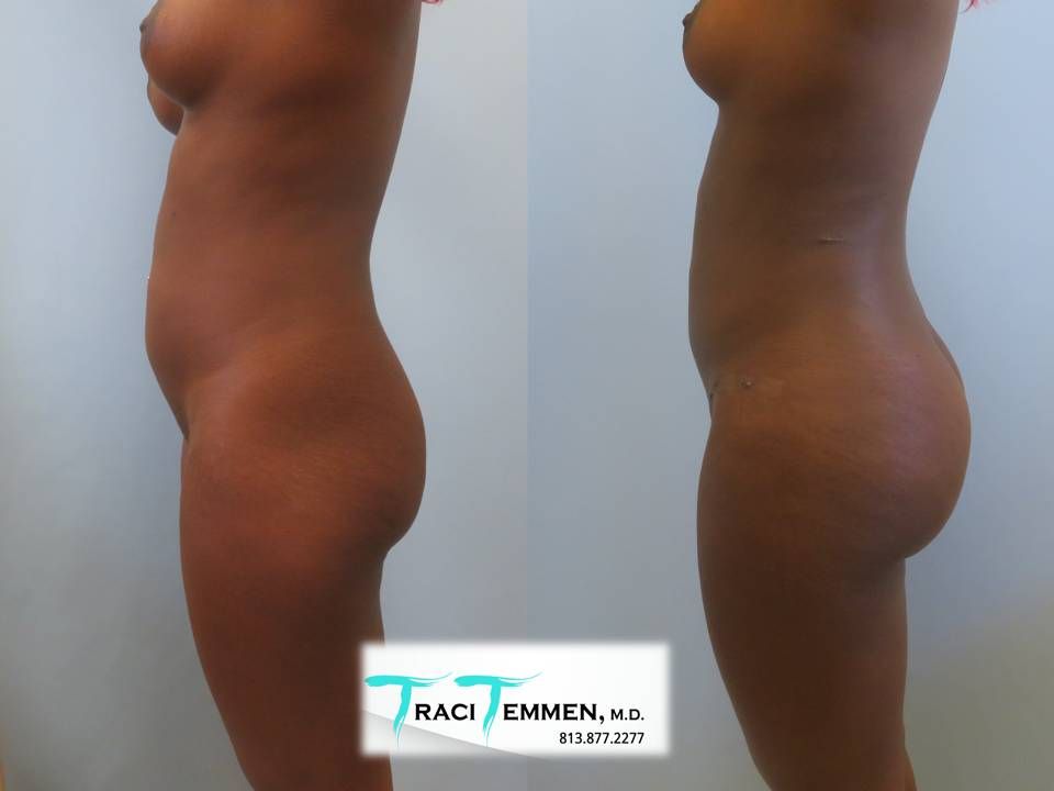 Brazilian Butt Lift Before & After