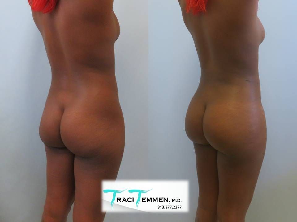 Brazilian Butt Lift Before & After