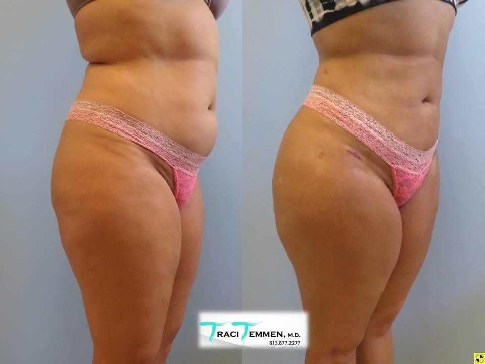 Brazilian Butt Lift Before & After