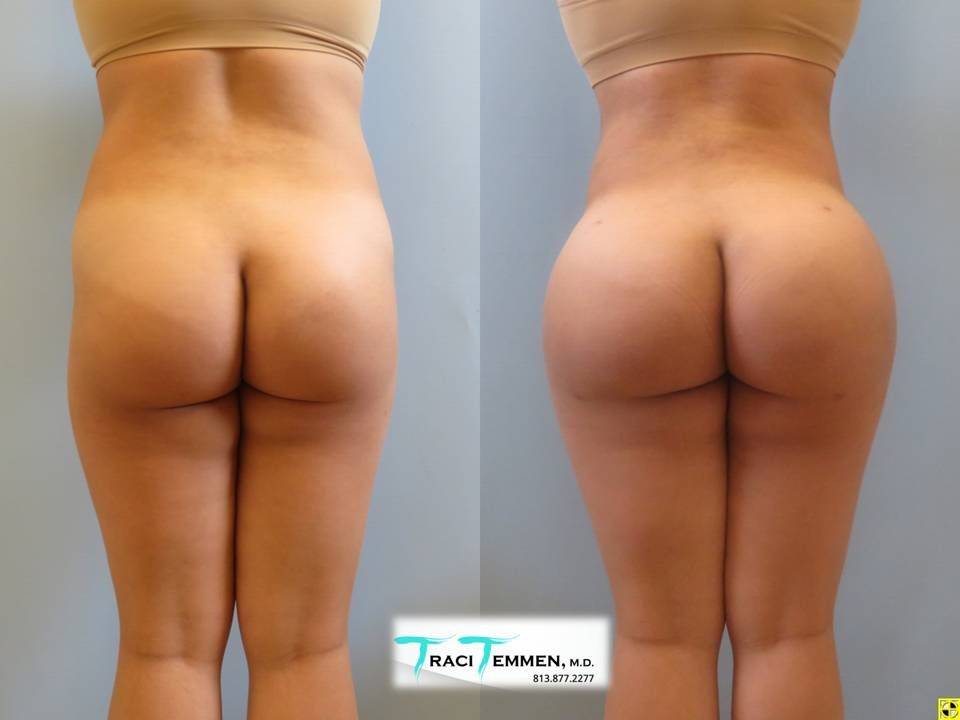 Brazilian Butt Lift Before & After