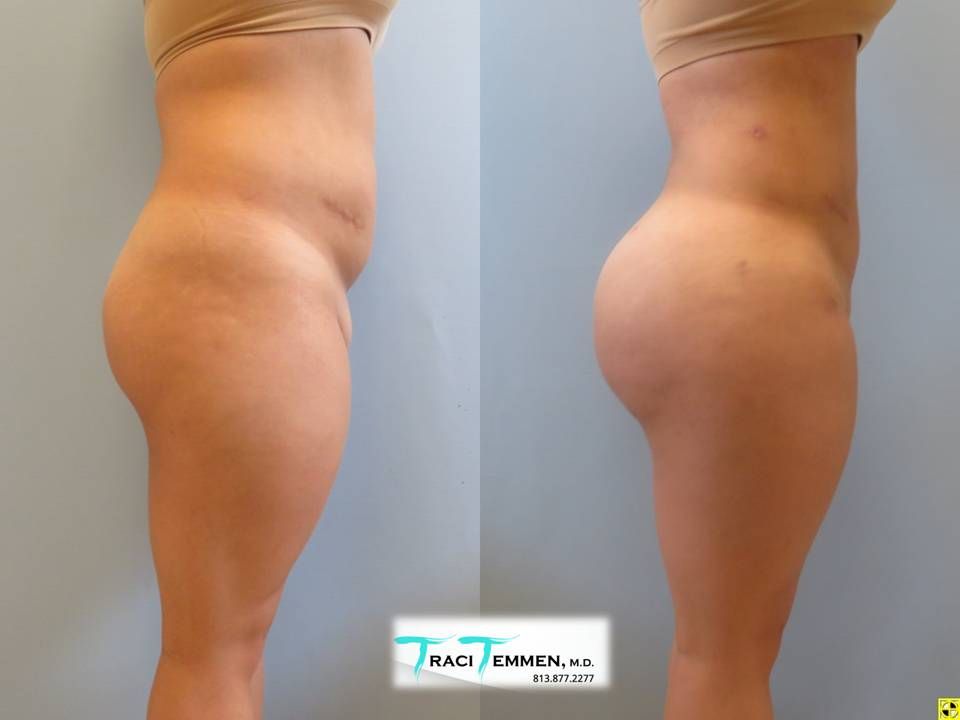 Brazilian Butt Lift Before & After