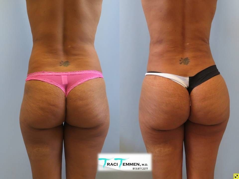 Brazilian Butt Lift Before & After