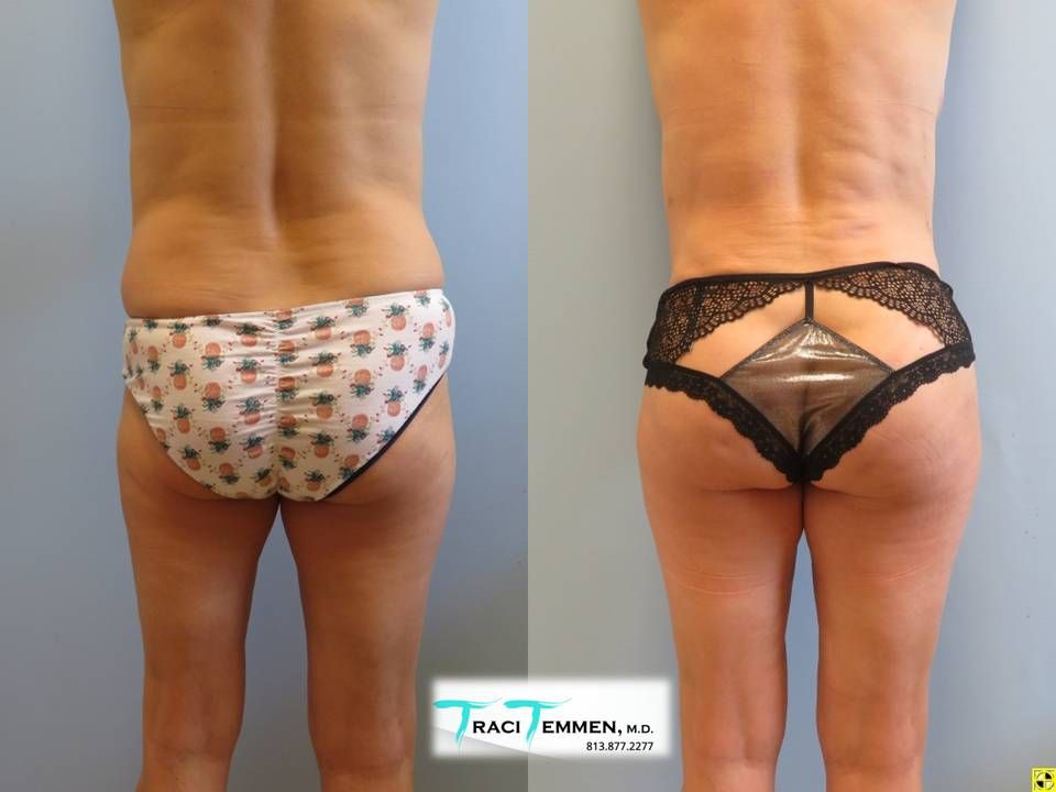 Brazilian Butt Lift Before & After